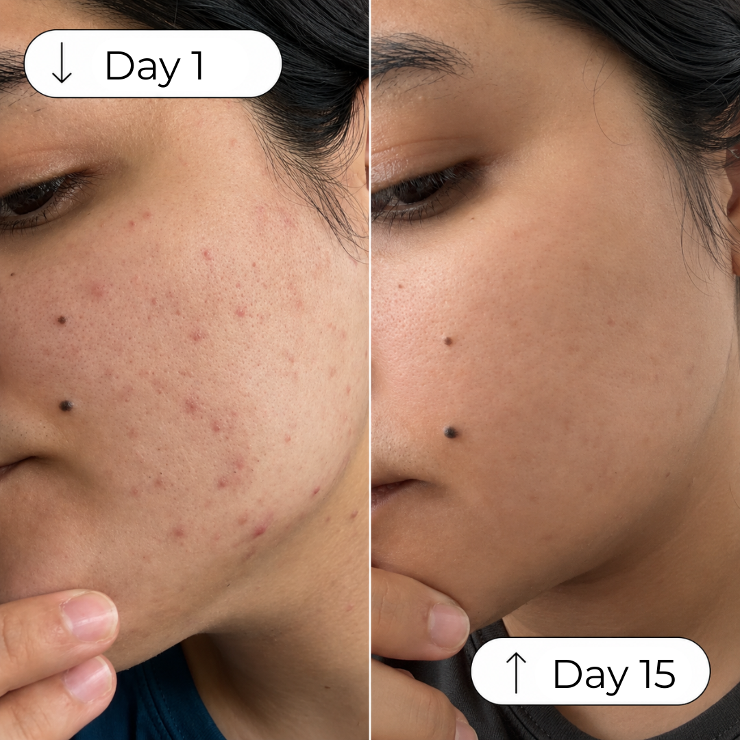 Clarifying Herbal Facial Serum | Facial Oil for Acne-Prone & Sensitive Skin | Handmade Botanical Skincare